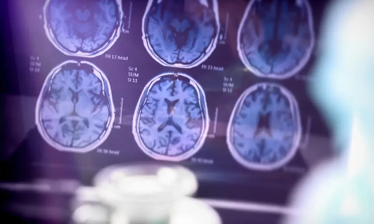 Alzheimer’s disease Alzheimer’s disease